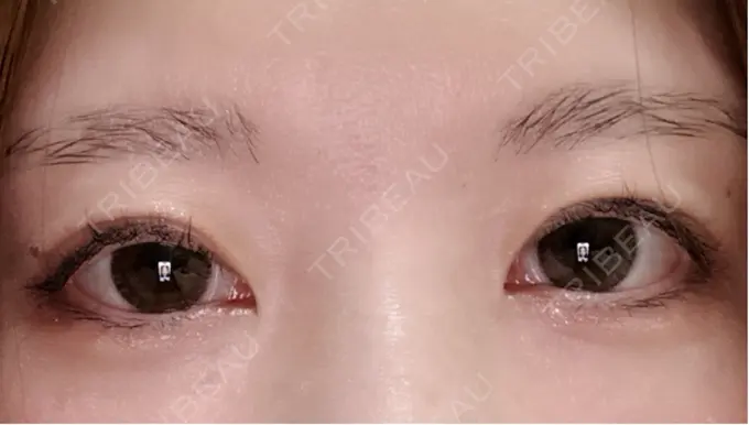 眼瞼下垂（非切開） SOL CLINIC DAY 48 メイン用