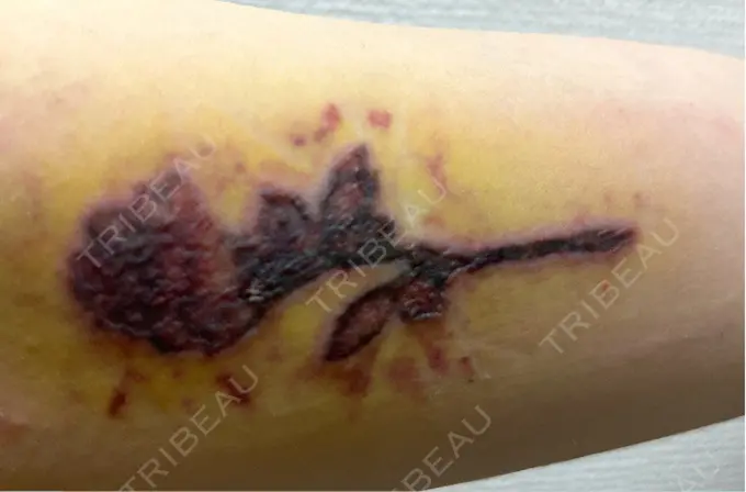 タトゥー除去 ルラ美容クリニック 福岡本院 DAY 3 メイン用