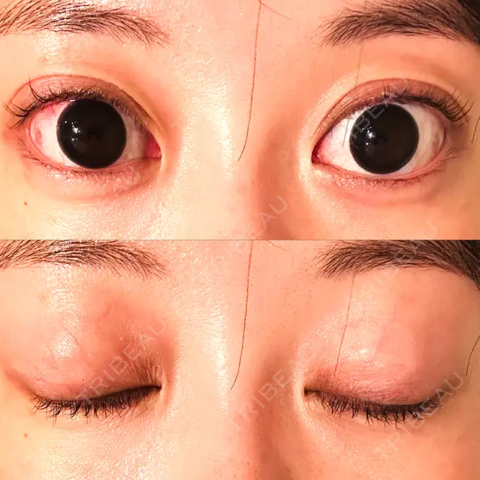 二重埋没 水の森美容クリニック 大阪梅田院 DAY 13 メイン用