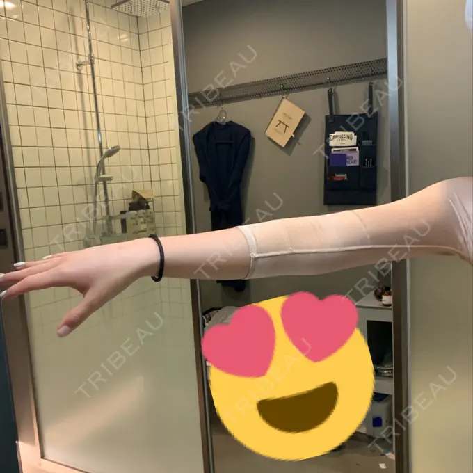 脂肪吸引（二の腕） / 脂肪吸引（お腹） ドクターフィット（Dr.fit）クリニック DAY 3 メイン用