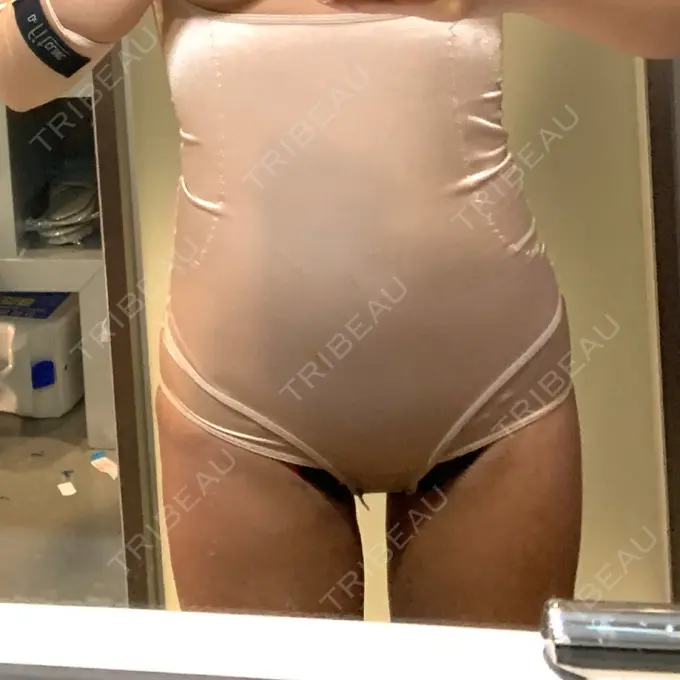 脂肪吸引（二の腕） / 脂肪吸引（お腹） ドクターフィット（Dr.fit）クリニック DAY 3 メイン用