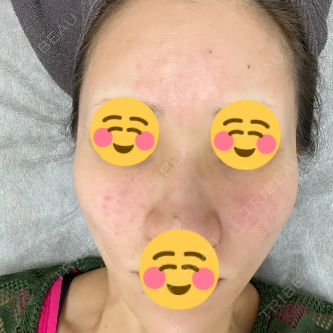 その他（肌） ギャラリークリニック 銀座 AFTER メイン用