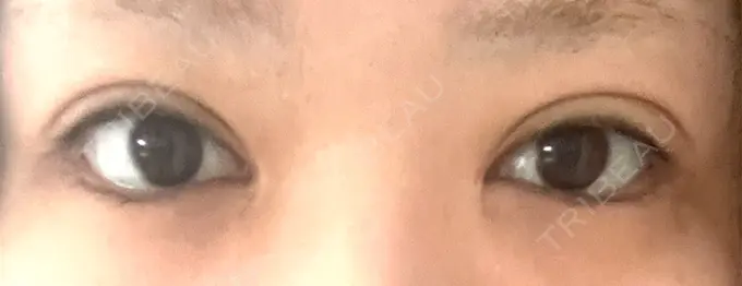 二重埋没 東京シンデレラ美容外科 大宮院 DAY 21 メイン用