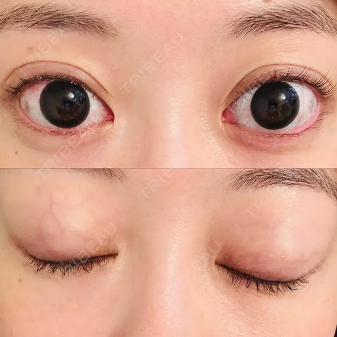 二重埋没 水の森美容クリニック 大阪梅田院 DAY 15 メイン用