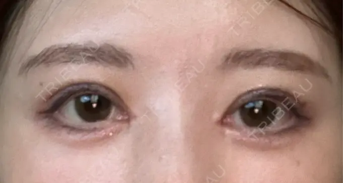 二重埋没 / 目頭切開 / クマ治療 ROOTS Clinic DAY 23 メイン用