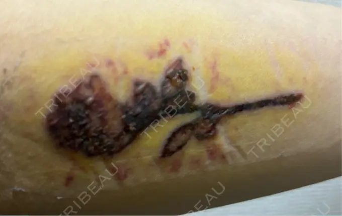 タトゥー除去 ルラ美容クリニック 福岡本院 DAY 4 メイン用