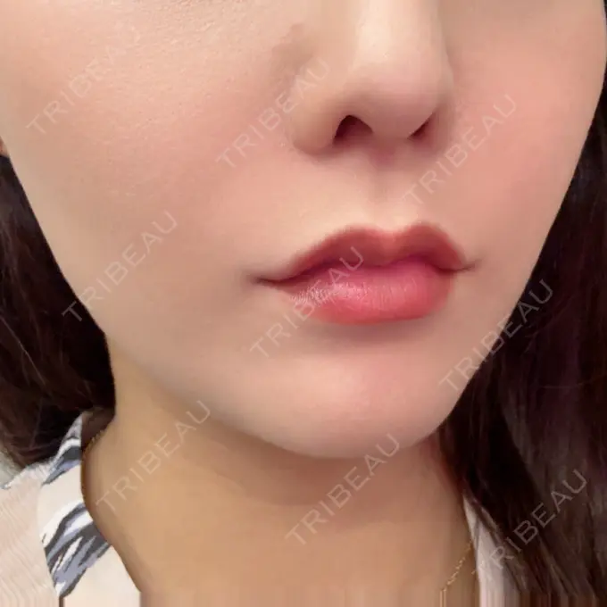 ヒアルロン酸注入（鼻翼基部） APスキンクリニック銀座 DAY 0 メイン用