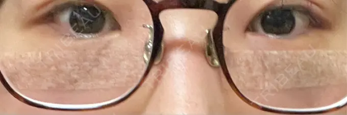 下まぶたの脂肪取り 吉井クリニック DAY 2 メイン用