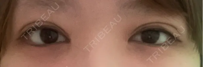 二重埋没 東京シンデレラ美容外科 大宮院 DAY 22 メイン用