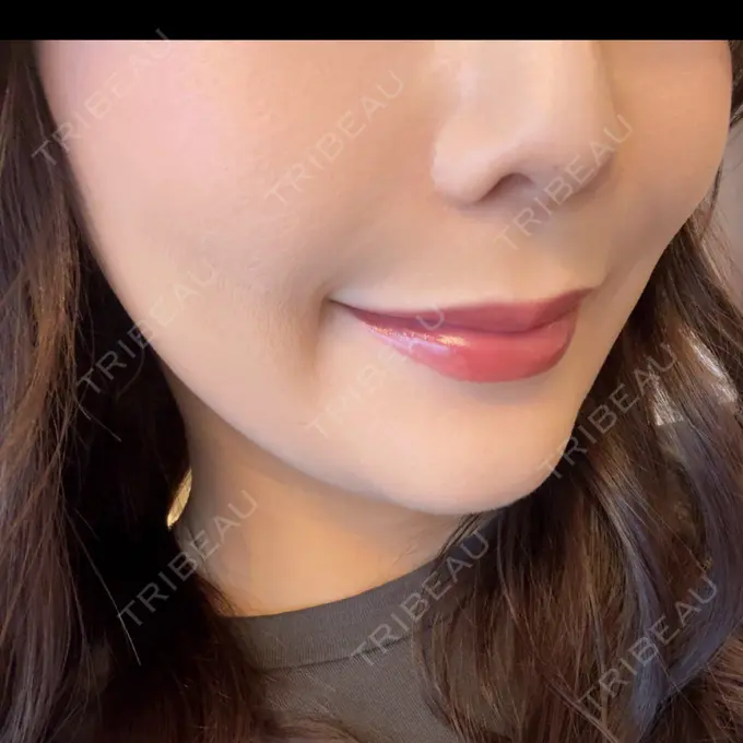 ヒアルロン酸注入（鼻翼基部） APスキンクリニック銀座 AFTER メイン用