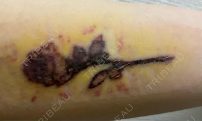 タトゥー除去 ルラ美容クリニック 福岡本院 DAY 5 メイン用