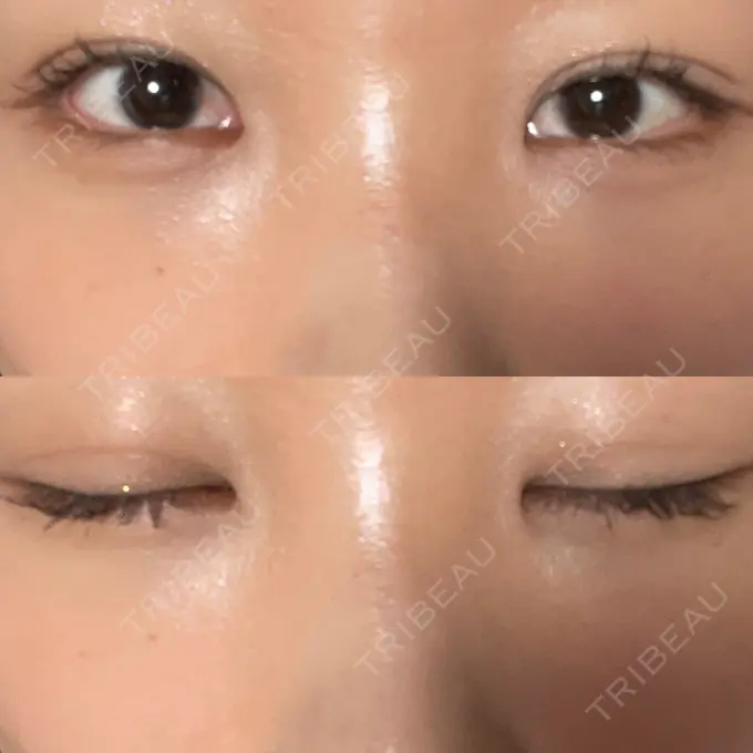 二重埋没 / クマ治療 / ボトックス（エラ・小顔） / ヒアルロン酸注入（額） / ボトックス（肩） / その他（目元） TCB東京中央美容外科 京都四条院 DAY 25 メイン用