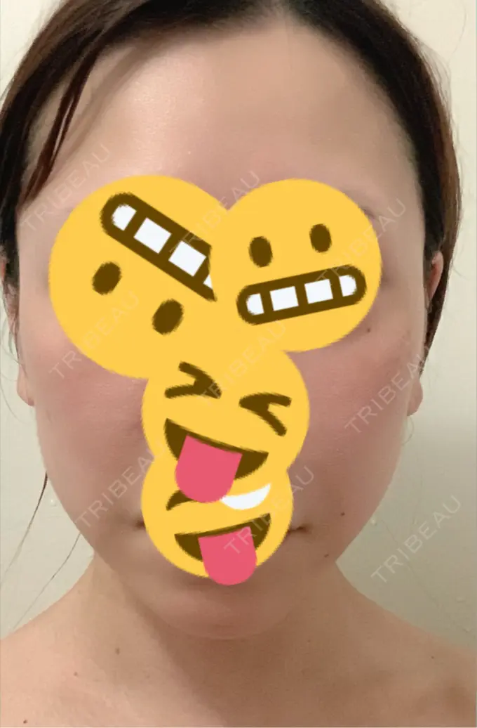 ボトックス（エラ・小顔） 東京形成美容外科 船橋院 DAY 23 メイン用