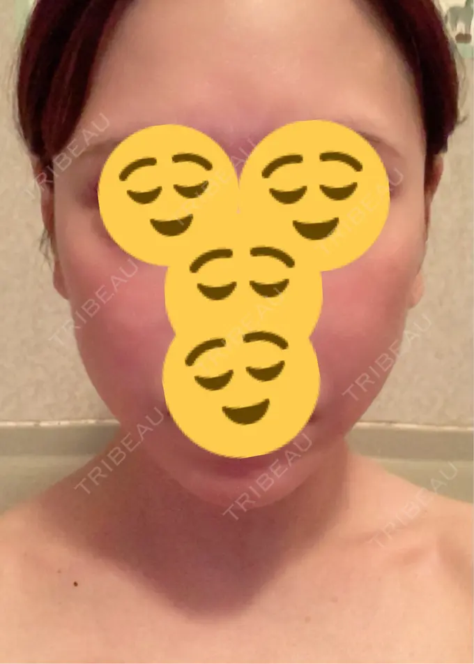 ボトックス（エラ・小顔） 東京形成美容外科 船橋院 DAY 25 メイン用