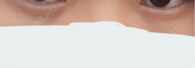 下まぶたの脂肪取り 吉井クリニック DAY 16 メイン用