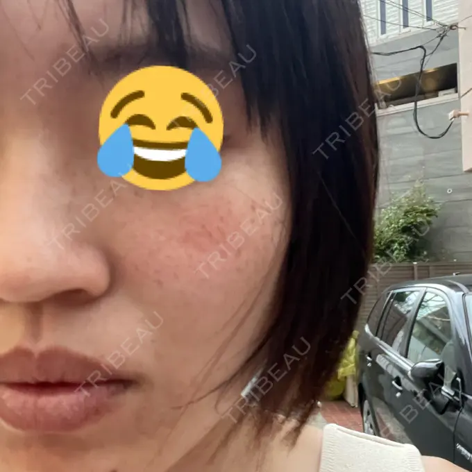 ピーリング（ハリ・ツヤ） / ルメッカ 表参道メディカルクリニック 表参道院 AFTER メイン用