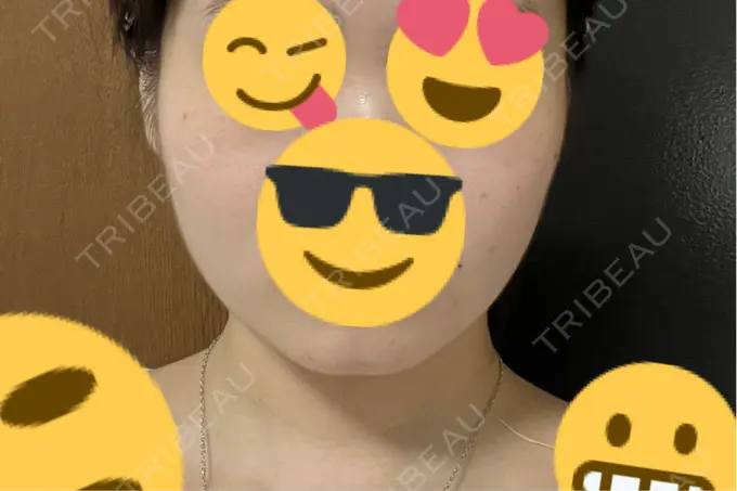 脂肪吸引（顔） Mods Clinic（モッズクリニック） 名古屋院 DAY 97 メイン用