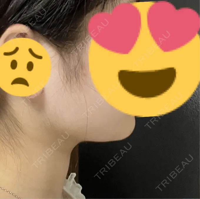 脂肪吸引（顔） Mods Clinic（モッズクリニック） 名古屋院 DAY 97 メイン用