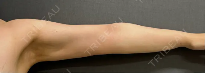 脂肪吸引（二の腕） ルーチェクリニック 銀座院 AFTER メイン用