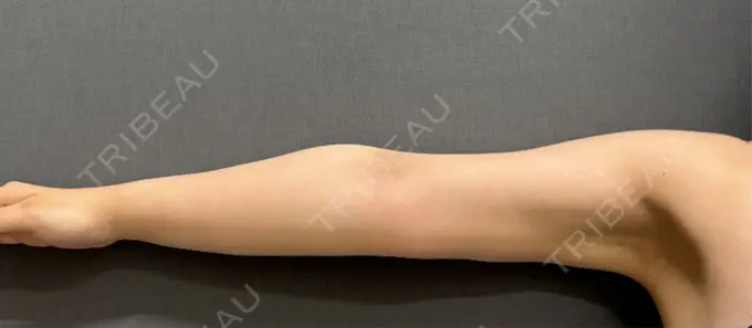 脂肪吸引（二の腕） ルーチェクリニック 銀座院 DAY 98 メイン用