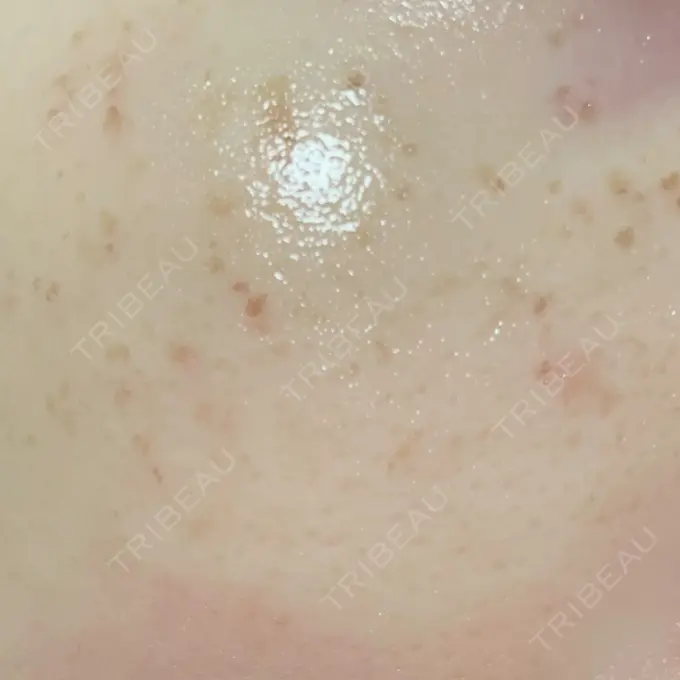 シミ取りレーザー Mavie Beauty Clinic （マヴィービューティークリニック） DAY 0 メイン用