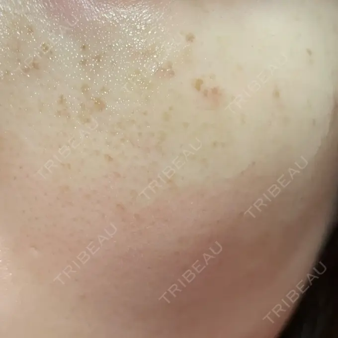 シミ取りレーザー Mavie Beauty Clinic （マヴィービューティークリニック） DAY 0 メイン用