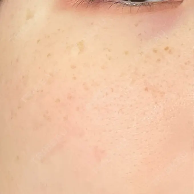 シミ取りレーザー Mavie Beauty Clinic （マヴィービューティークリニック） DAY 7 メイン用