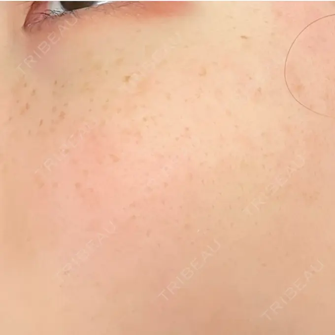 シミ取りレーザー Mavie Beauty Clinic （マヴィービューティークリニック） DAY 7 メイン用