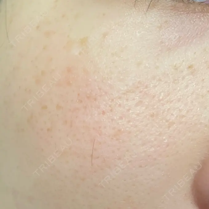 シミ取りレーザー Mavie Beauty Clinic （マヴィービューティークリニック） AFTER メイン用