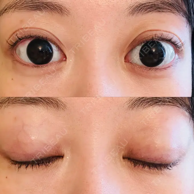 二重埋没 水の森美容クリニック 大阪梅田院 AFTER メイン用