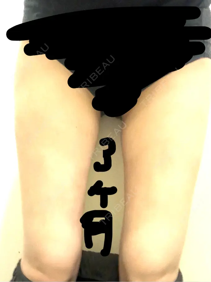 脂肪吸引（脚） / 医療痩身（太もも） Mods Clinic（モッズクリニック） 大阪院 DAY 35 メイン用