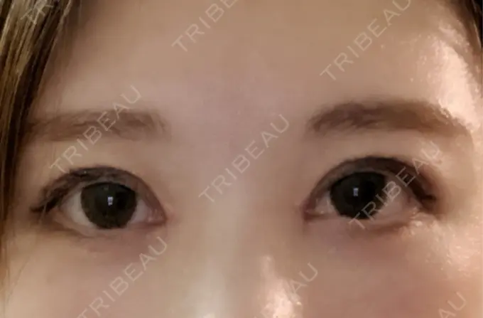 二重埋没 / 目頭切開 / クマ治療 ROOTS Clinic DAY 24 メイン用