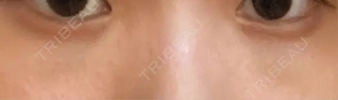 下まぶたの脂肪取り 吉井クリニック AFTER メイン用