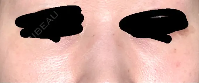 クマ治療 / 下まぶたの脂肪取り / 脂肪注入（目の下） 吉井クリニック AFTER メイン用