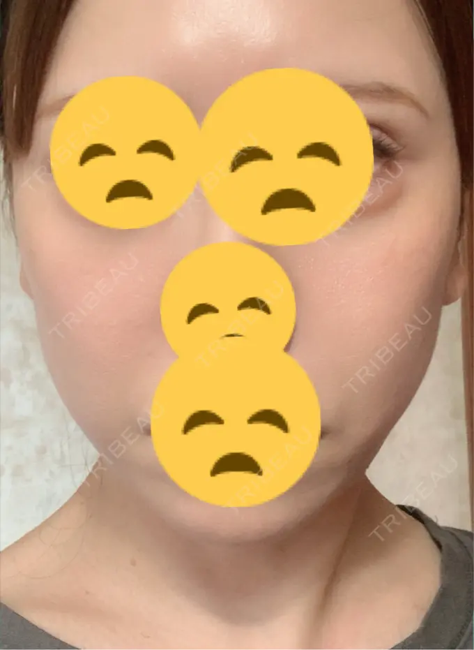 ボトックス（エラ・小顔） 東京形成美容外科 船橋院 DAY 27 メイン用