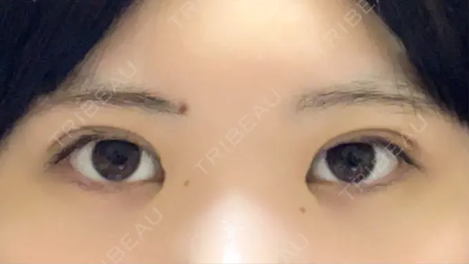二重埋没 / 目頭切開 東京シンデレラ美容外科 池袋院 DAY 13 メイン用