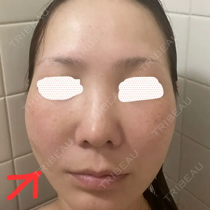 糸リフト / クマ治療 / 肌ヒアルロン酸注入（たるみ・シワ改善） ルラ美容クリニック 静岡院 DAY 8 メイン用