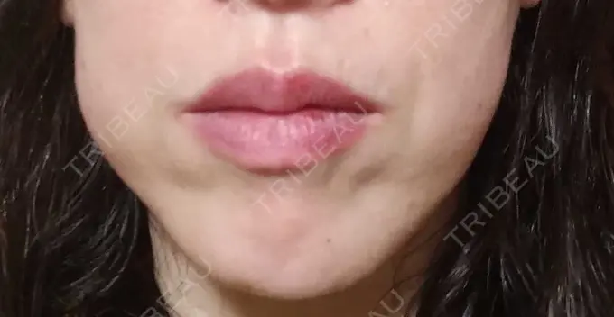 ボトックス（エラ・小顔） TCB東京中央美容外科 金山院 DAY 42 メイン用