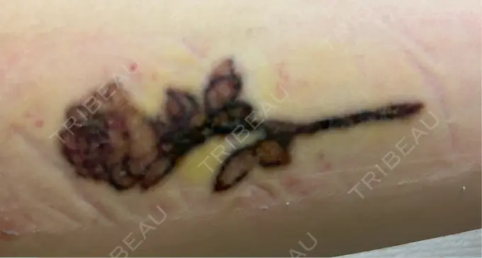 タトゥー除去 ルラ美容クリニック 福岡本院 DAY 7 メイン用