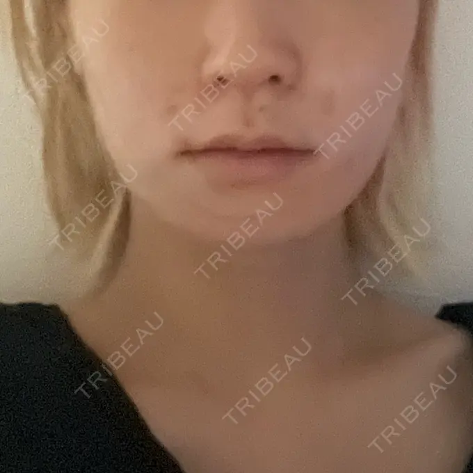 糸リフト / 脂肪吸引（顔） / ボトックス（エラ・小顔） RIVER CLINIC（リバークリニック） DAY 0 メイン用