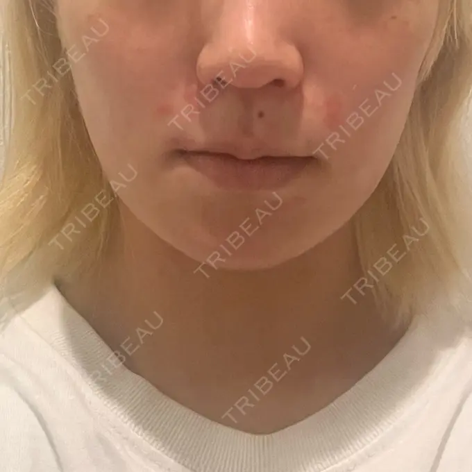 糸リフト / 脂肪吸引（顔） / ボトックス（エラ・小顔） RIVER CLINIC（リバークリニック） DAY 1 メイン用