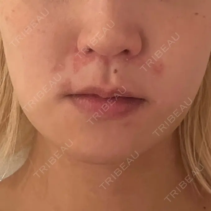 糸リフト / 脂肪吸引（顔） / ボトックス（エラ・小顔） RIVER CLINIC（リバークリニック） DAY 4 メイン用