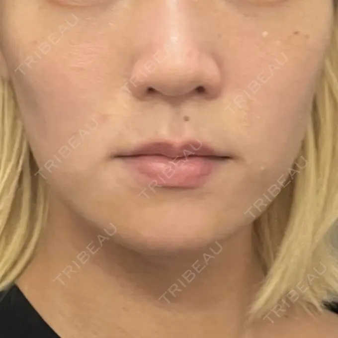 糸リフト / 脂肪吸引（顔） / ボトックス（エラ・小顔） RIVER CLINIC（リバークリニック） DAY 11 メイン用