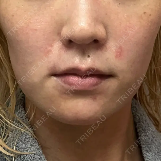 糸リフト / 脂肪吸引（顔） / ボトックス（エラ・小顔） RIVER CLINIC（リバークリニック） AFTER メイン用