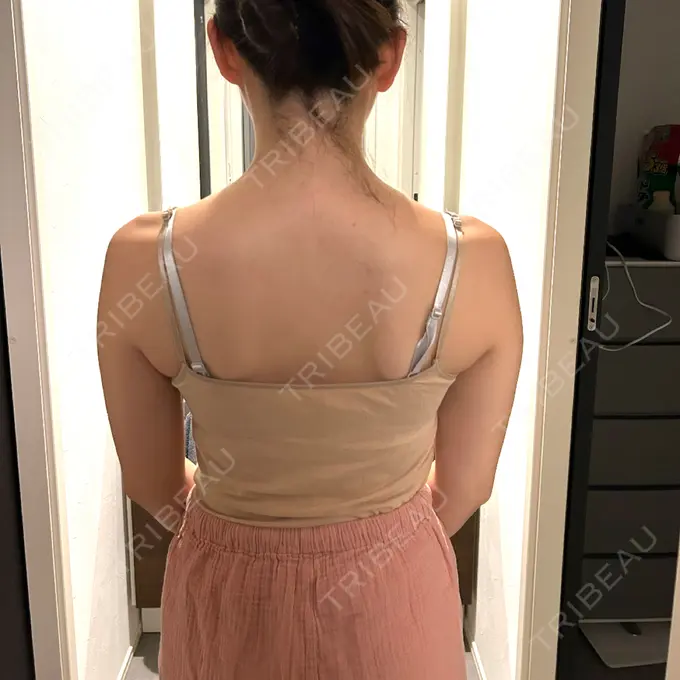 ボトックス（肩） BiBiクリニック AFTER メイン用