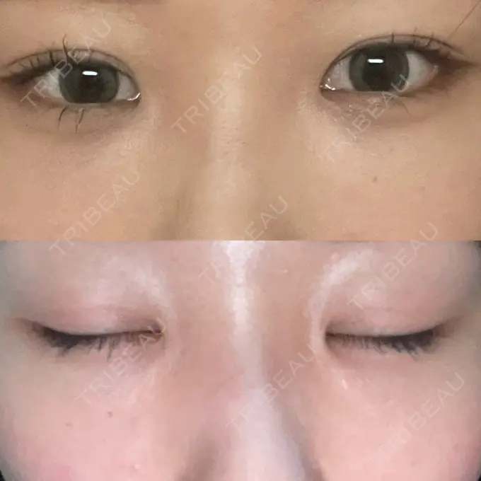 二重埋没 / クマ治療 / ボトックス（エラ・小顔） / ヒアルロン酸注入（額） / ボトックス（肩） / その他（目元） TCB東京中央美容外科 京都四条院 AFTER メイン用