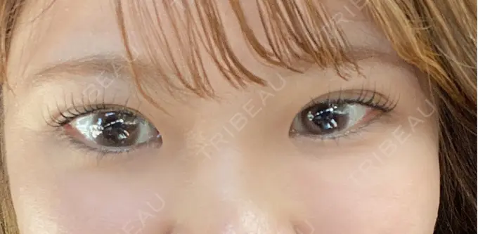 二重埋没 / 脂肪溶解注射（顔） / ボトックス（眉間） / ボトックス（額） / その他（鼻） X CLINIC 恵比寿院 AFTER メイン用