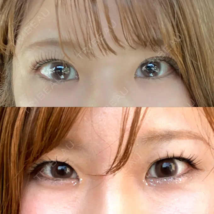 二重埋没 / 脂肪溶解注射（顔） / ボトックス（眉間） / ボトックス（額） / その他（鼻） X CLINIC 恵比寿院 DAY 83 メイン用