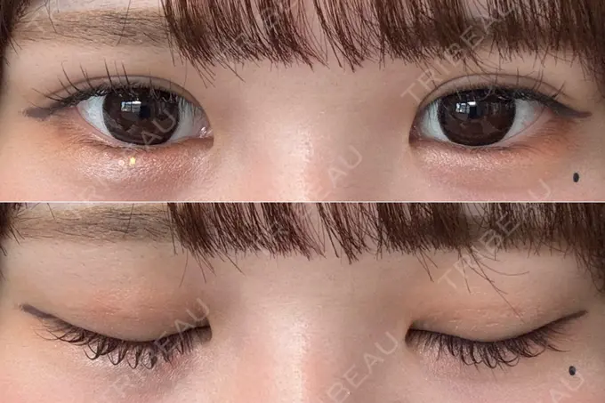 二重埋没 / 上まぶたの脂肪取り THE FIRST CLINIC 多摩センター院 DAY 31 メイン用