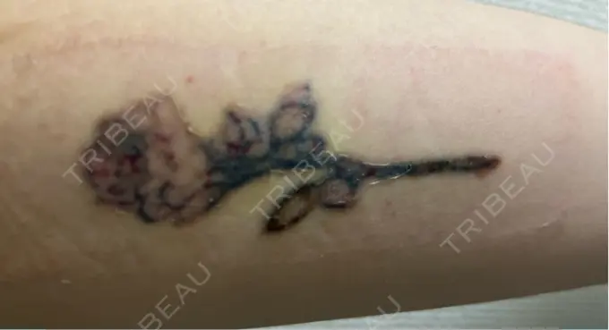 タトゥー除去 ルラ美容クリニック 福岡本院 DAY 10 メイン用